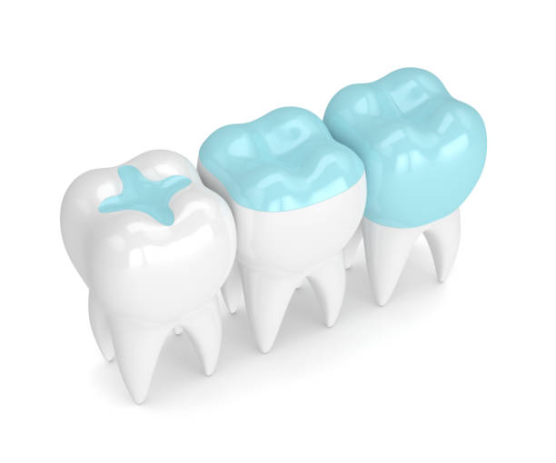 ¡Todo Sobre Restauraciones Dentales!